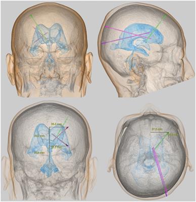 Reconsidering Ventriculoperitoneal Shunt Surgery and Postoperative Shunt Valve Pressure Adjustment: Our Approaches Learned From Past Challenges and Failures